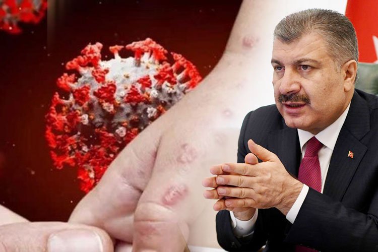 Bakan Koca açıkladı… Türkiye’de ilk maymun çiçeği vakası görüldü!